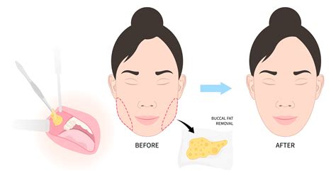 buccal fat removal leeds|Buccal Fat Removal: How It Works, Cost, Risks.